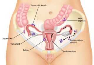Endometriozis Nedir? Belirtileri, Nedenleri ve Tedavi Yöntemleri 2025
