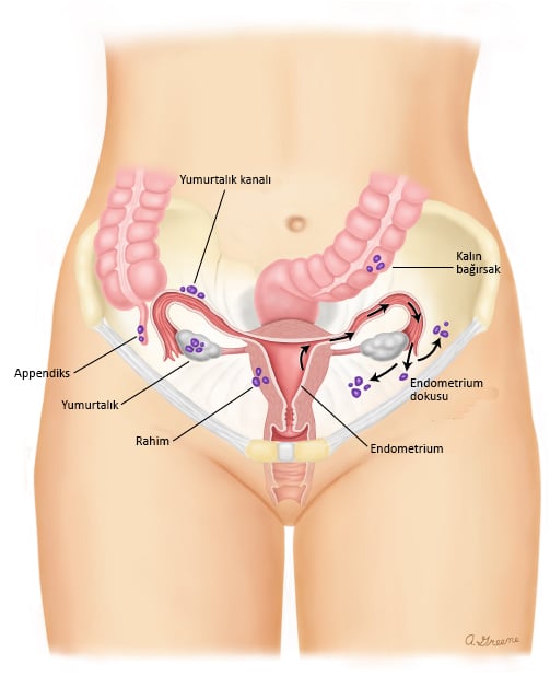 endometriozis nedir