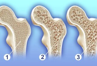 Kadınlarda Kemik Erimesi Belirtileri: Tanı, Tedavi ve Önleme Yöntemleri 2025