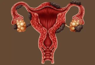 Çikolata Kisti Nedir? Belirtileri, Tedavisi ve Yanlış Bilinenler 2025